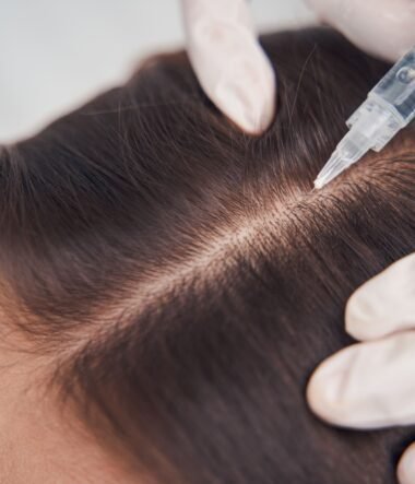 Everything you need to know about PRP Hair Restoration Treatment