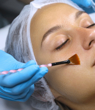Why Winter is the Best Time for a Chemical Peel Treatment