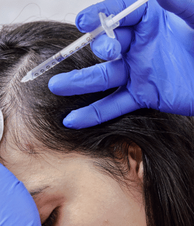 Why PRP Hair Treatment is Becoming Popular in California, USA