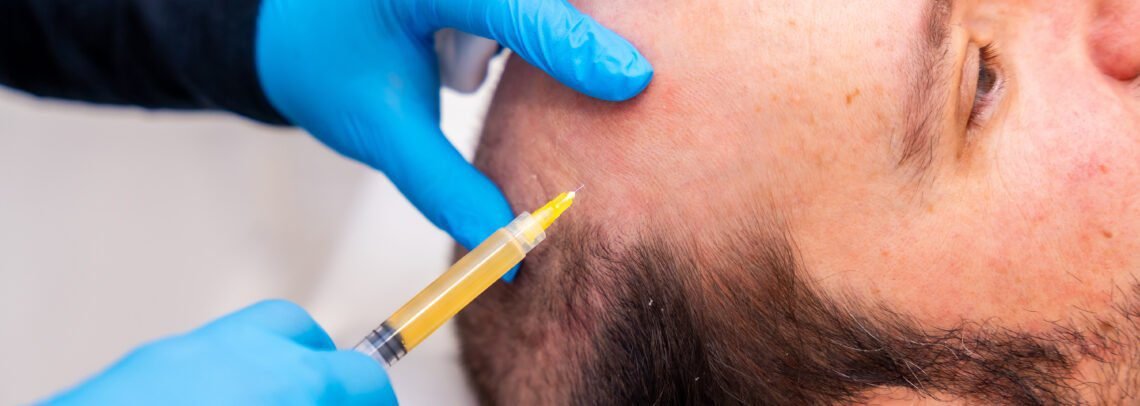 PRF vs PRP for Hair Restoration: Which Is Better?