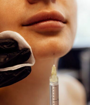 How Long Do Dermal Fillers Actually Last?