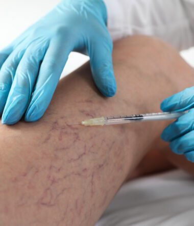 Spider Veins on Your Legs Understanding What Treatment Can Actually Do